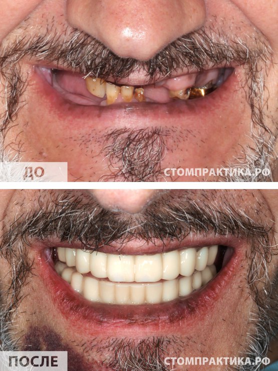 Фотография до и после установки зубных протезов в клинике СТОМПРАКТИКА